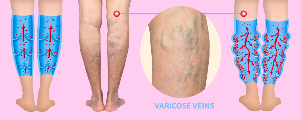 varicosis