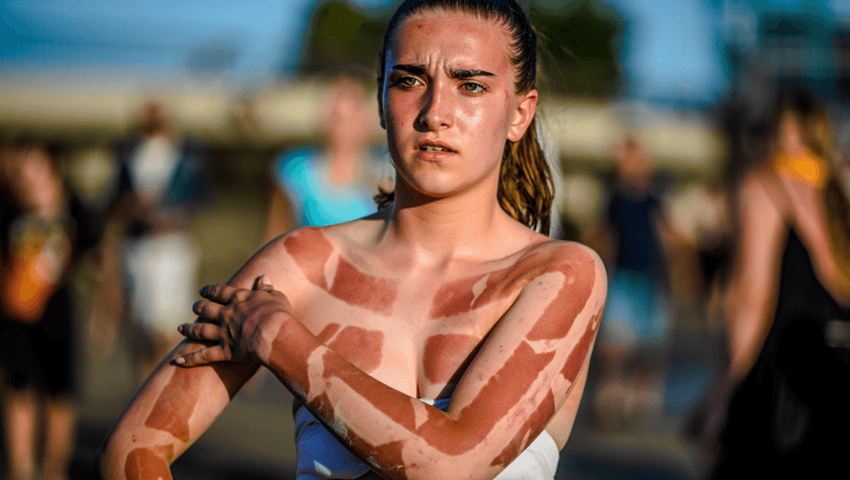 Sonnenbrand-Tattoos: Deutsche Krebshilfe warnt vor gefährlichem Trend Wer einen Sonnenbrand in Kauf nimmt, um kreative Muster und Tan Lines in die Haut zu brennen, hat ein mindestens doppelt so hohes Risiko, später an Hautkrebs zu erkranken. Mehr erfahren