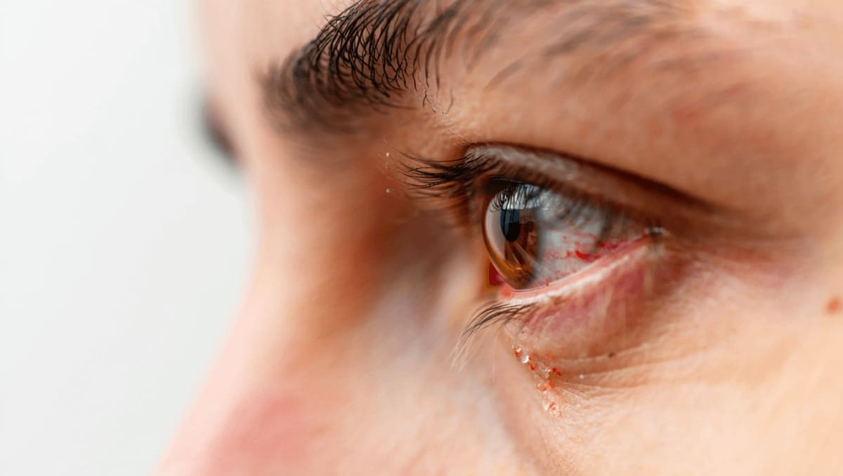 Schwimmbad-Konjunktivitis: Chlamydien als Auslöser